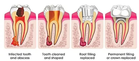 Root Canal Treatment in malleswaram