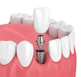 Dental implants in malleswaram